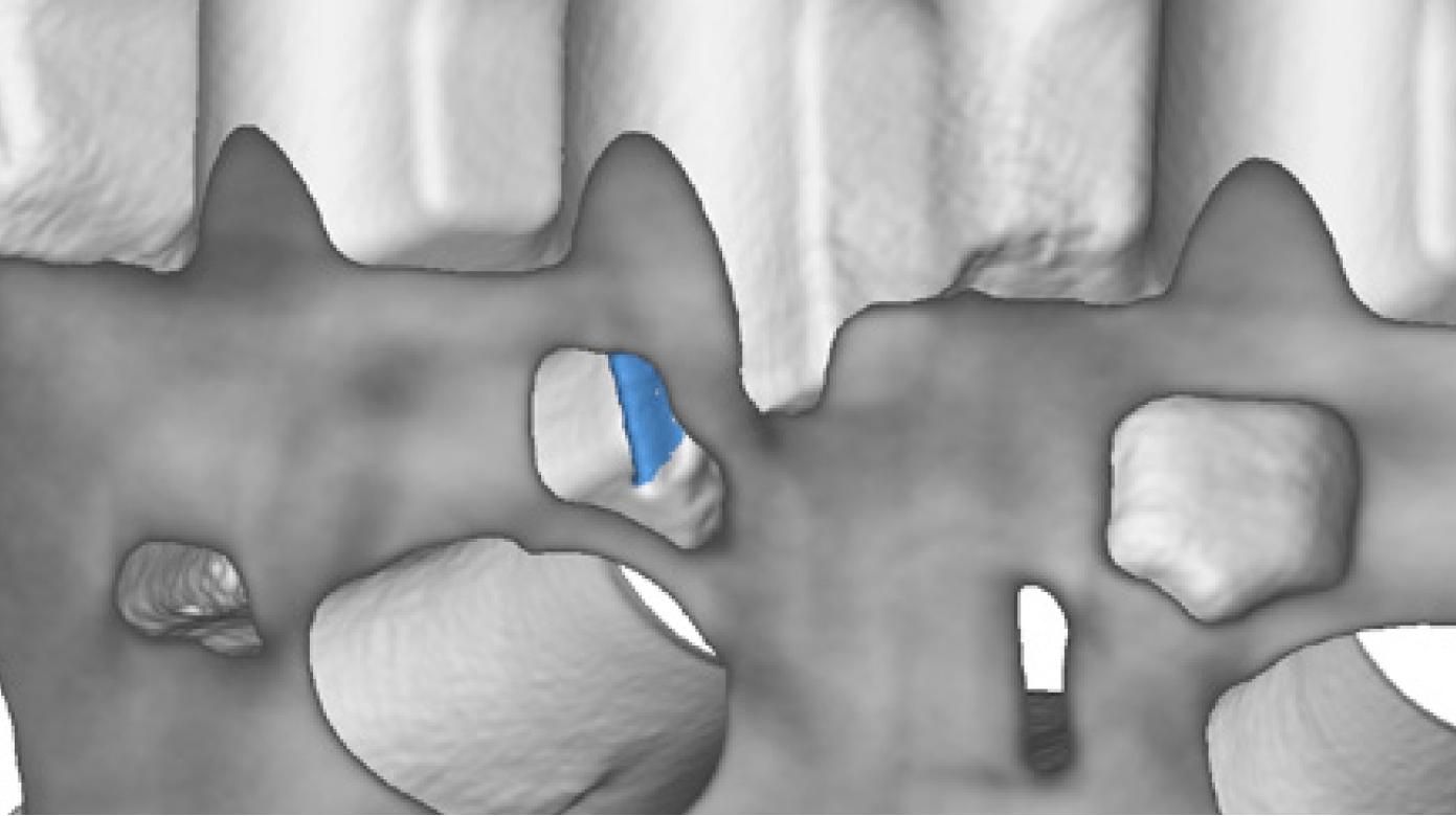 ZEISS Rottura dell’anima in metallo leggero