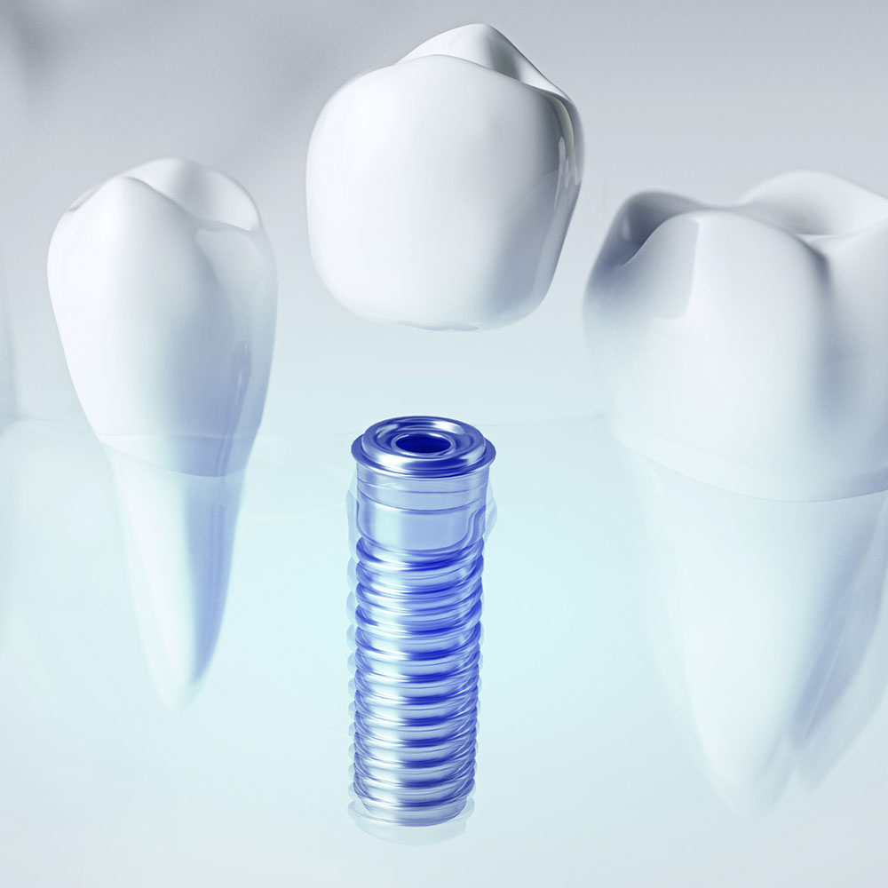 Impianti dentali