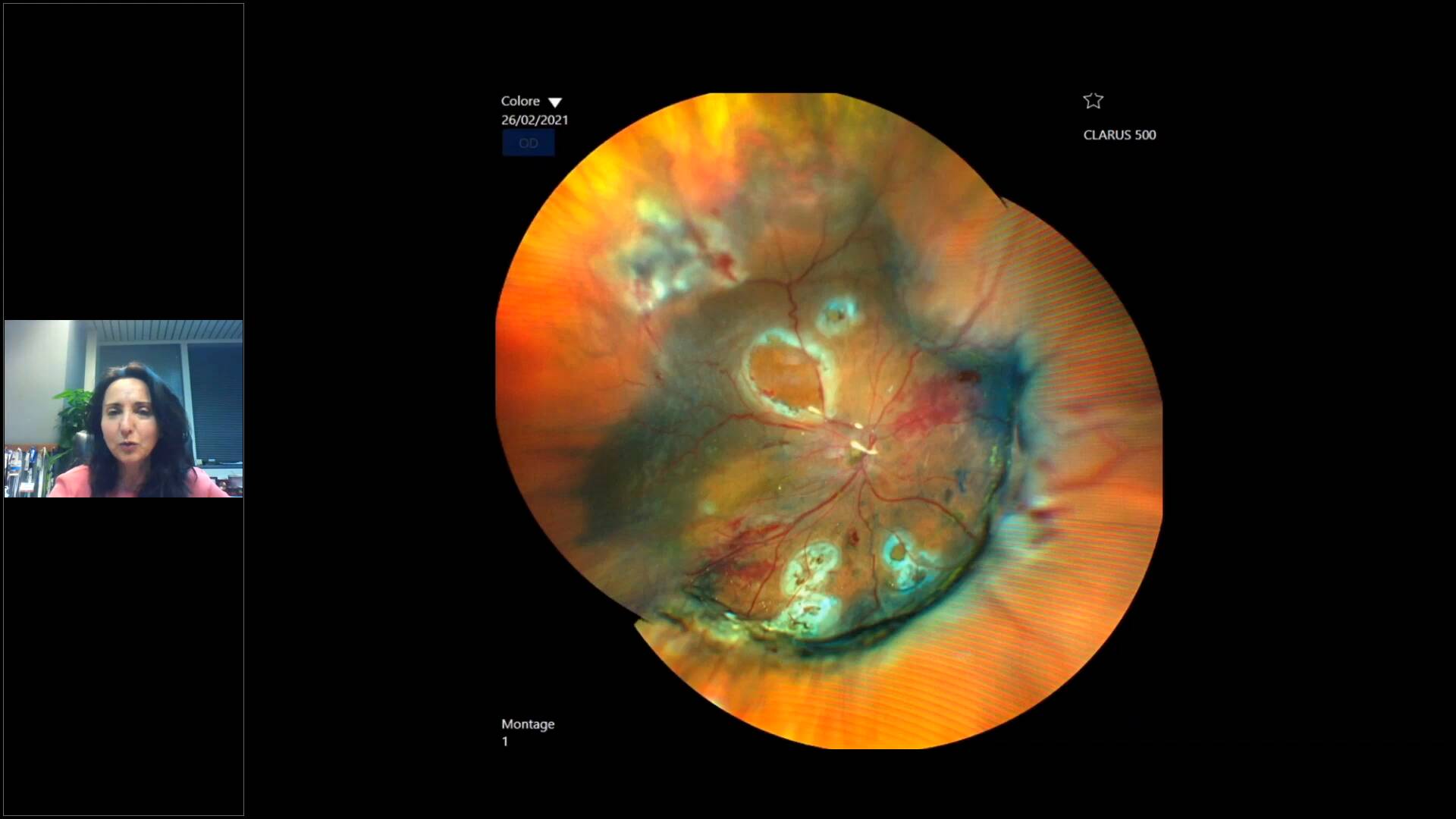  Imaging ultra-widefield senza compromessi con CLARUS 