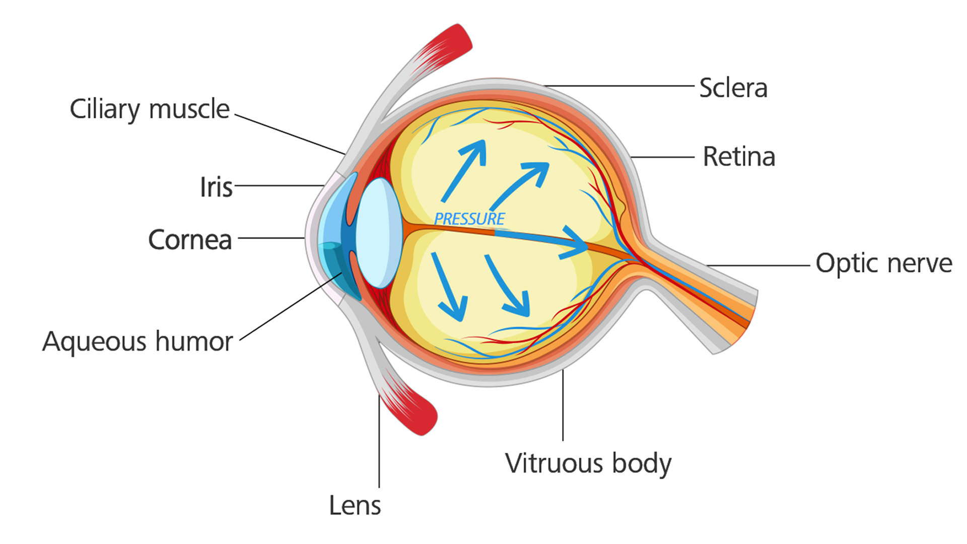 Occhio con glaucoma: la pressione oculare aumenta danneggiando il nervo ottico.