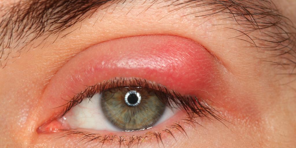 Blefarite all'occhio: cause pi� comuni, sintomi e rimedi