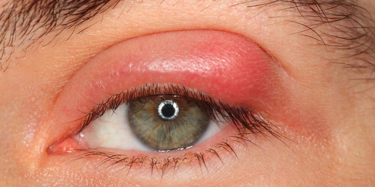 Occhio affetto da blefarite