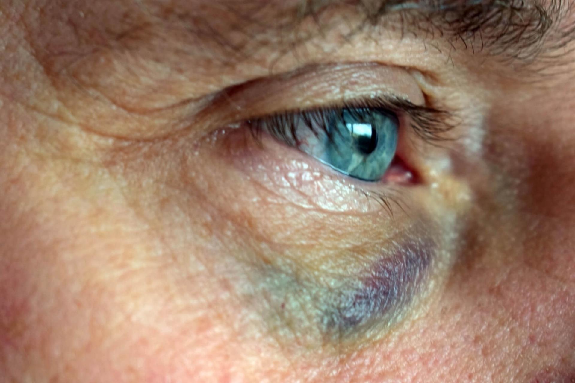 A causa di un forte impatto, i vasi sanguigni dell'occhio possono scoppiare e la parte bianca dell'occhio (la sclera) apparirà rossa e iniettata di sangue.