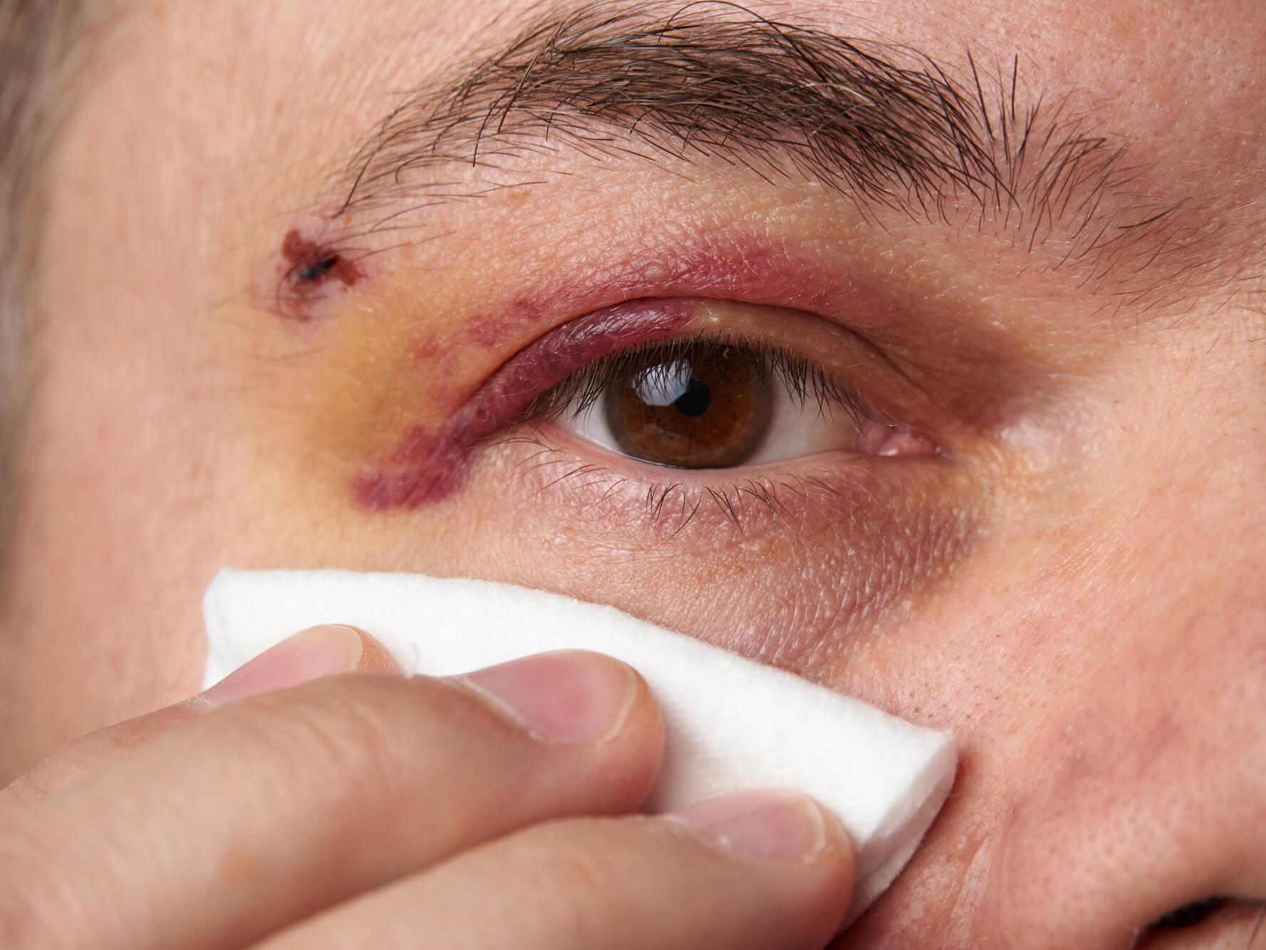 Applicare qualcosa di freddo sull'occhio subito dopo una lesione può ridurre il gonfiore e lenire il dolore.