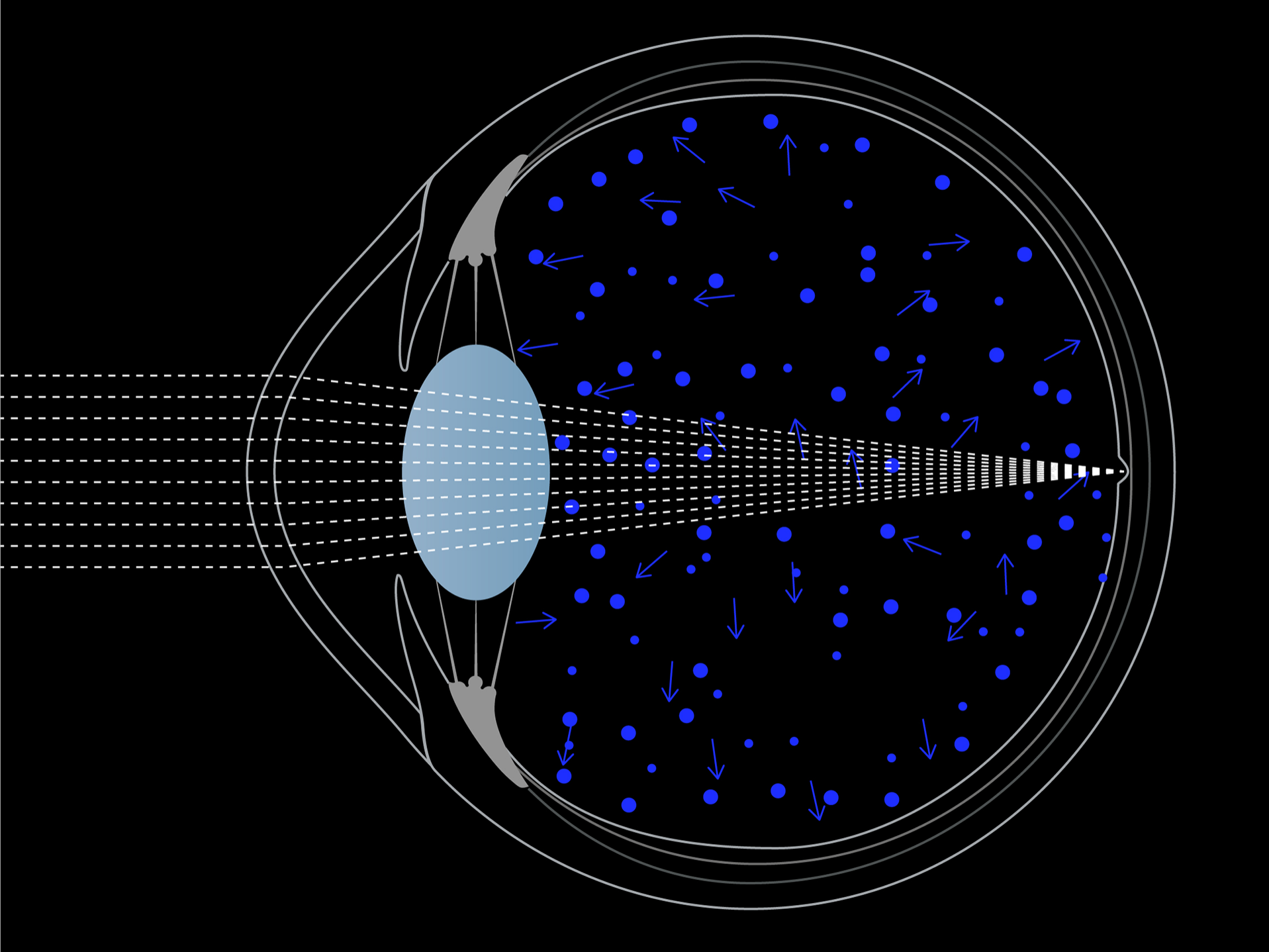 Illustrazione della luce che entra nell&apos;occhio, che mostra come la luce blu si diffonda maggiormente nell&apos;occhio rispetto alla luce bianca. 