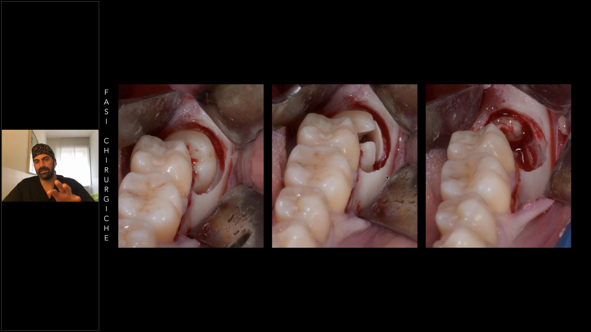L’estrazione del terzo molare inferiore: l’utilizzo del microscopio operatorio in chirurgia orale 