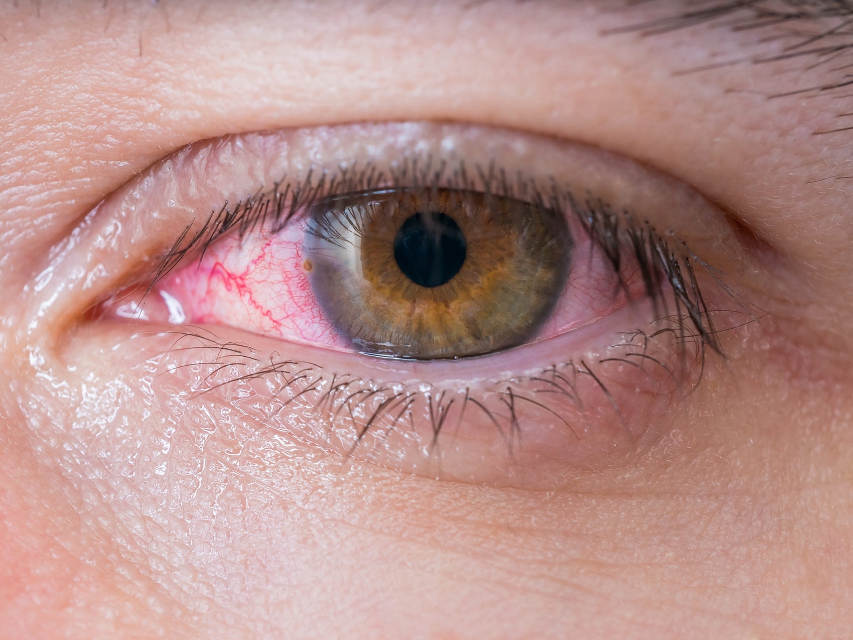 L'immagine mostra il primo piano di un occhio malato, che illustra l'aspetto di potenziali pericoli per gli occhi. 